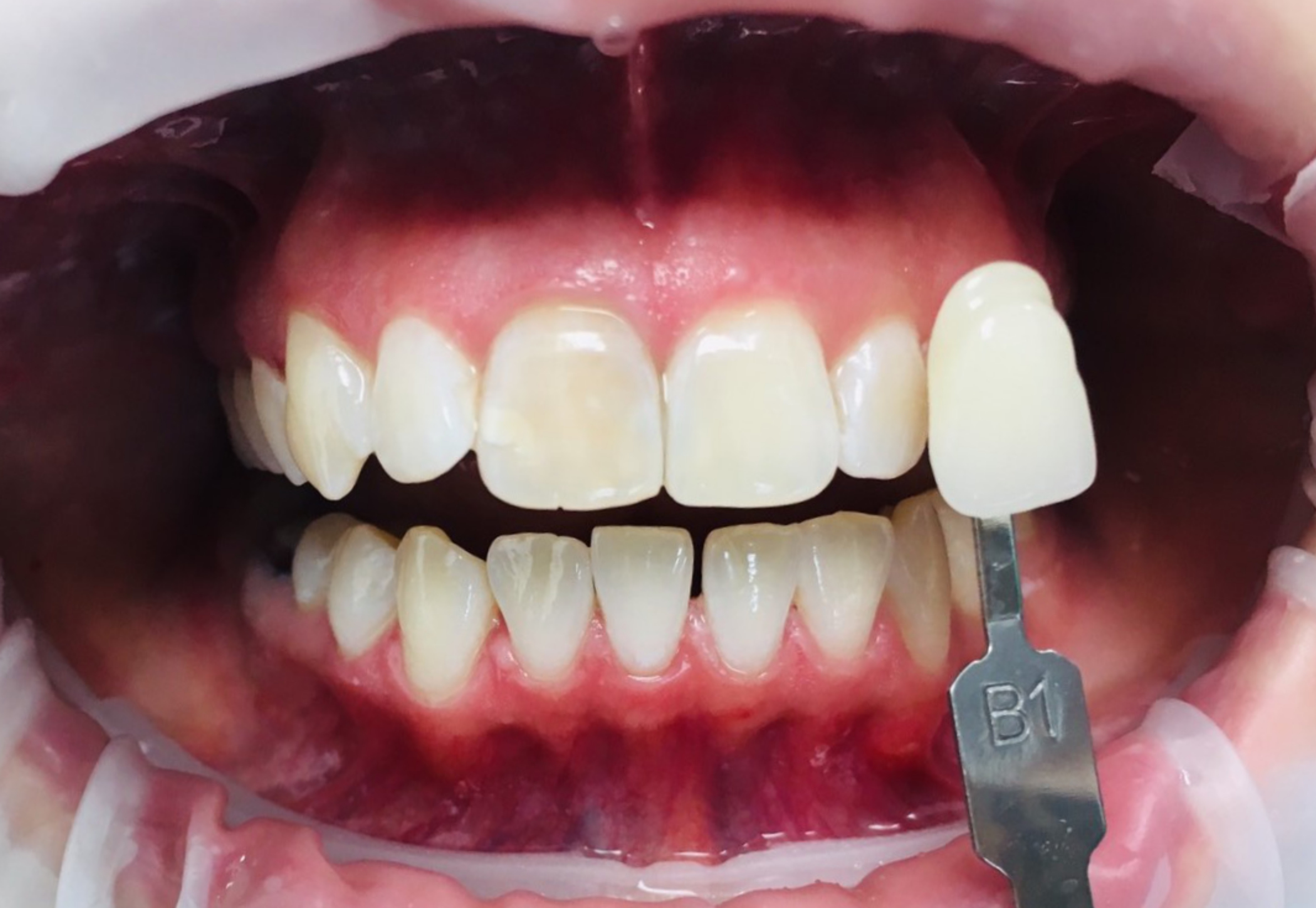 Отбеливание зубов системой ZOOM! WhiteSpeed (ZOOM!4)