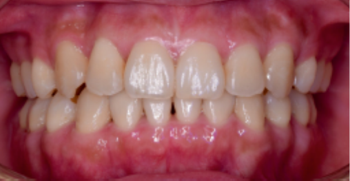 Пример лечения скученности зубов элайнерами 