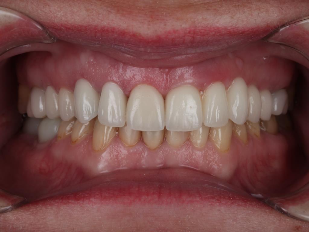 Тотальная реставрация зубов имплантами и коронками
