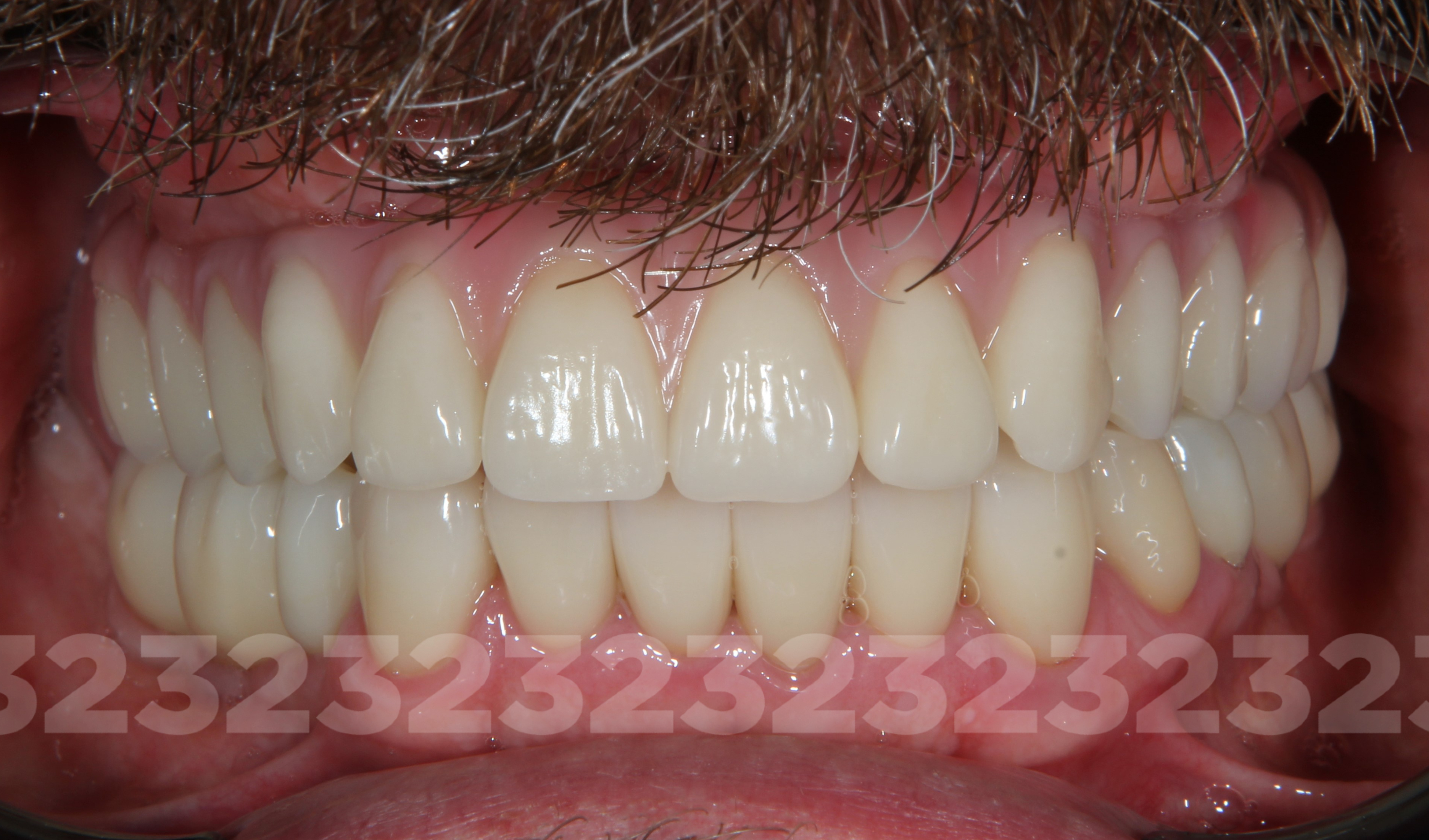 Имплантация зубов методом «All-on-4» («Все на 4-х»)