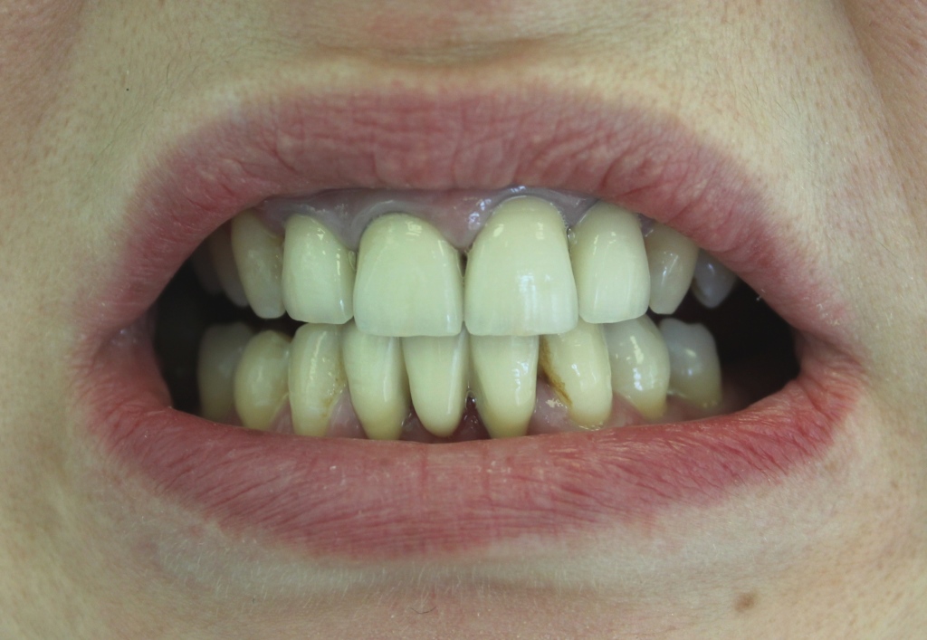 Восстановление разрушенных зубов конструкциями из диоксид циркония