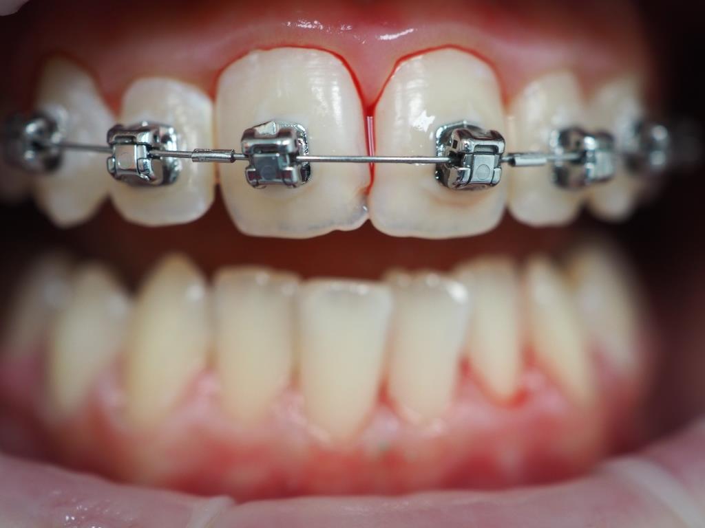 Профессиональная чистка зубов с брекет-системой в подростковом возрасте