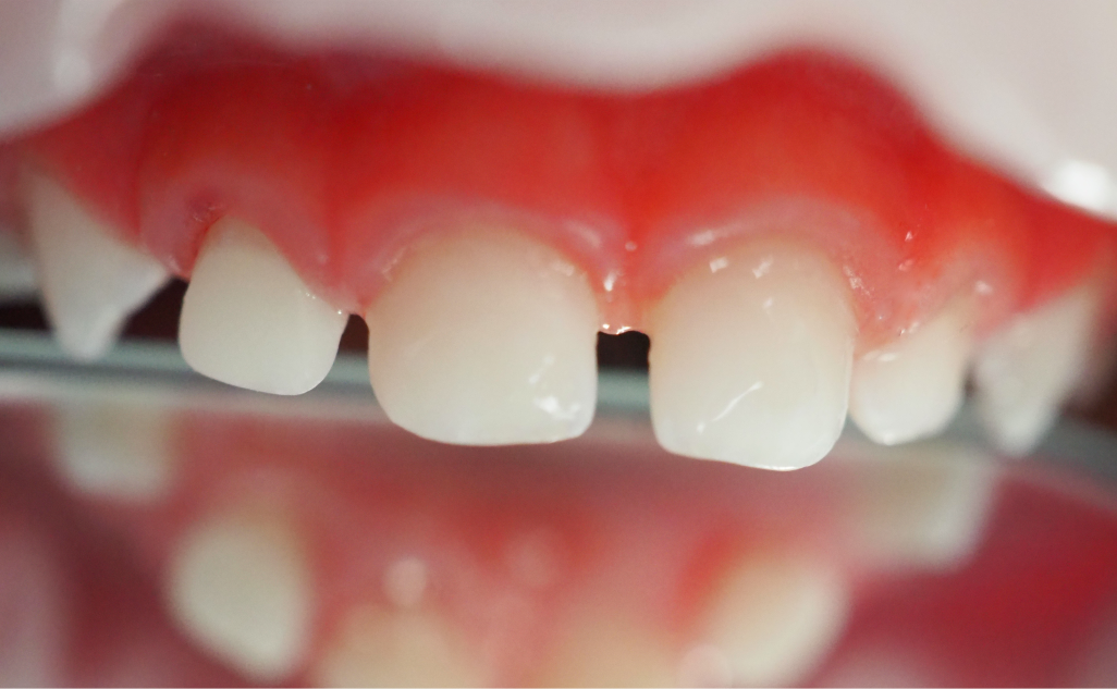 Восстановление молочных зубов металлическими коронками